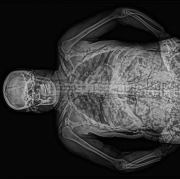 Obtained X-ray Image from FOBOS XR